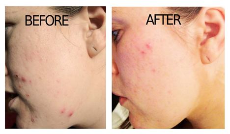 Mary, before and after six week Proactiv treatment