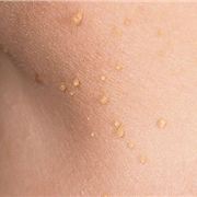 Skin Tags