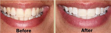 Lynda's teeth, before and after