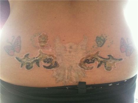 Tattoo removal - only slightly faded