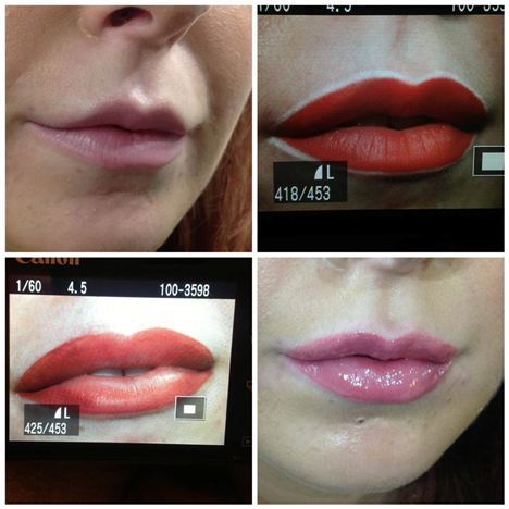 The four stages of Hobson's lip procedures%3B before, coloured in, immediately after and the final result.